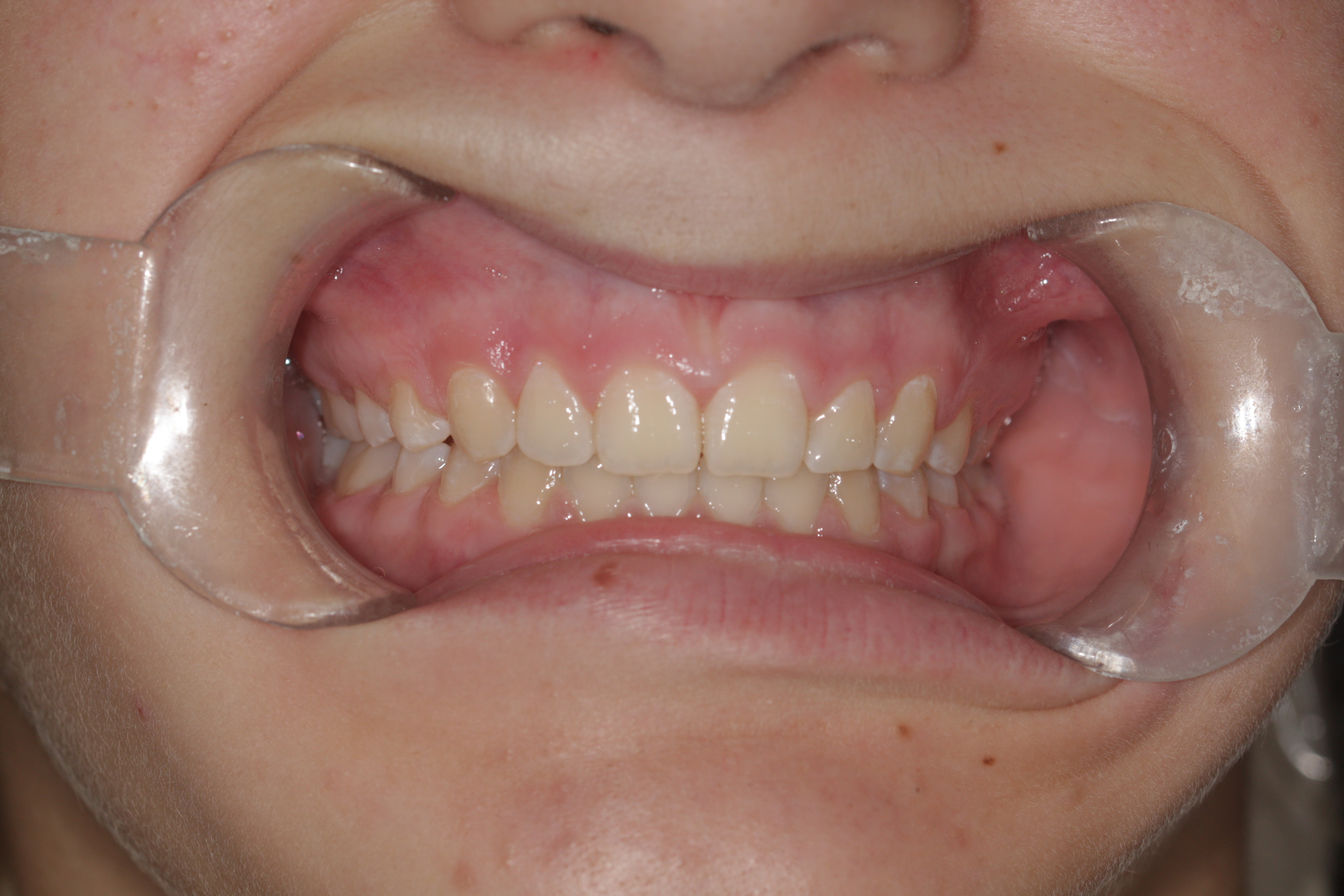 Bright Smiles Before and After Shots